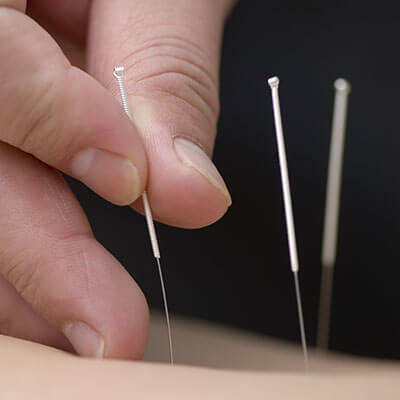 Acupuncture-in-St.-Charles-IL